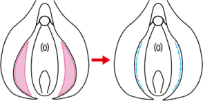 小陰唇縮小